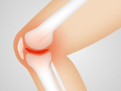 Chocolate and its influence on reducing Osteoarthritis